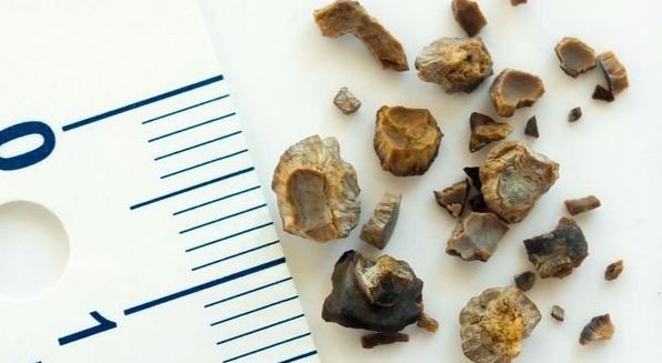 9 способів уникнути утворення каменів у нирках у новорічні свята і не тільки