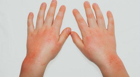 Алергія на холод на руках і обличчі взимку, що з нею робити і як лікувати