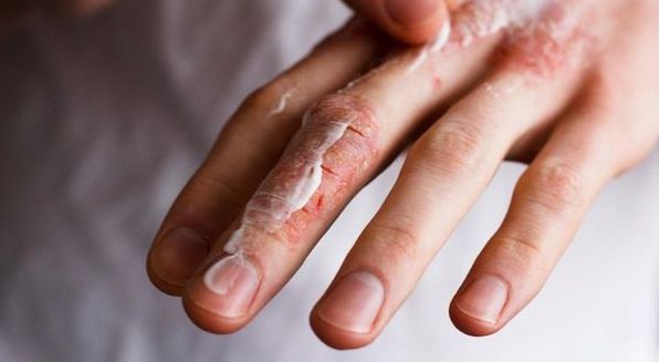 Алергія на холод на руках і обличчі взимку, що з нею робити і як лікувати