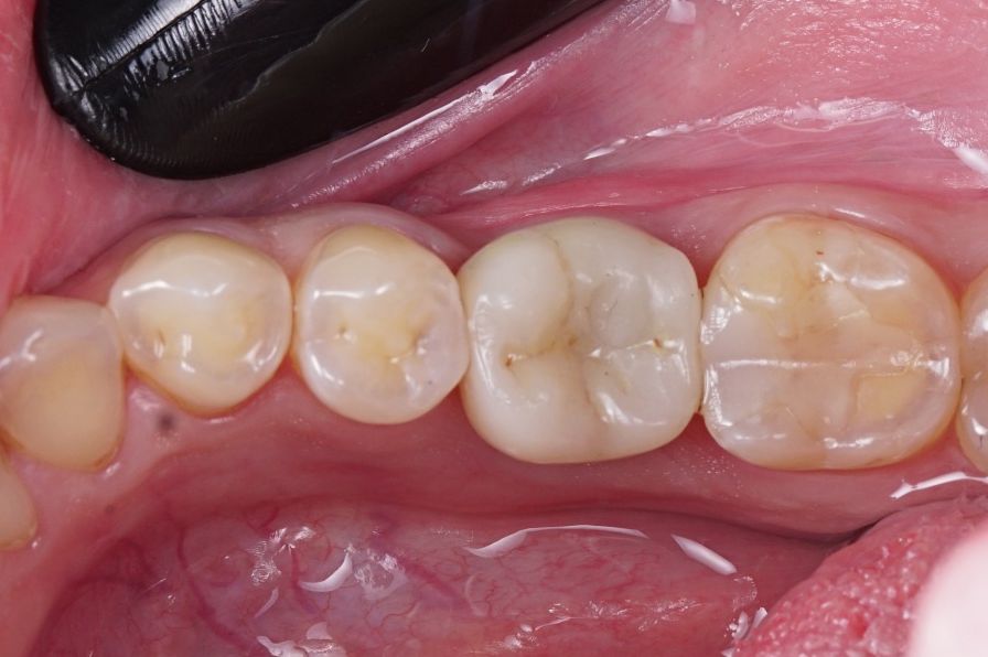 Що таке "імплантація зубів під ключ"?