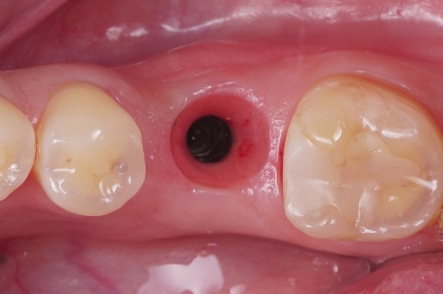 Що таке "імплантація зубів під ключ"?